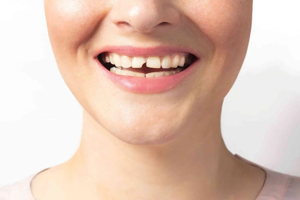 A smile with a chipped front tooth