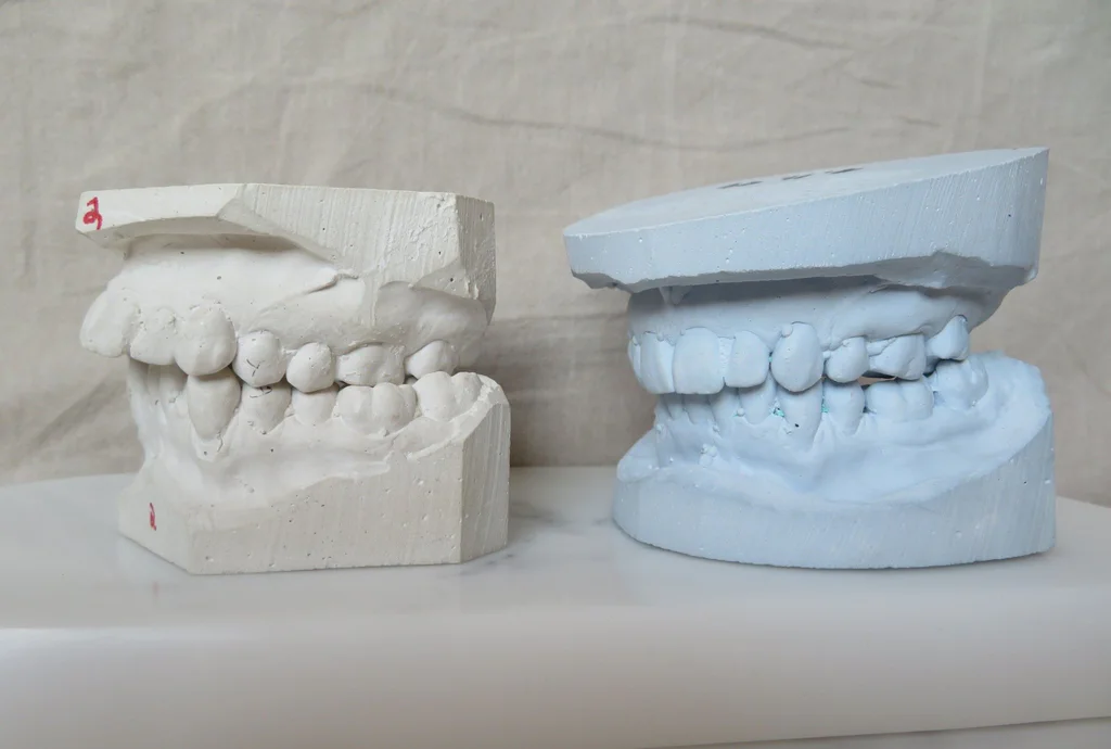 Two plaster dental models made from traditional impressions